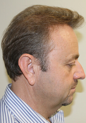 hair transplant photos