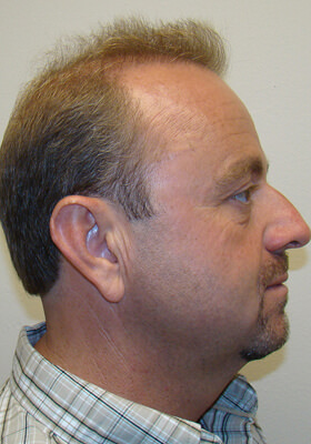 hair transplant before after Photos