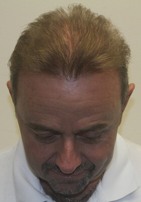 hair transplant photos