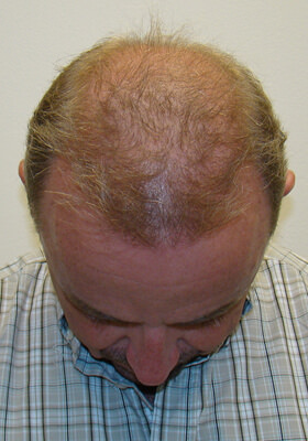 hair transplant before after Photos