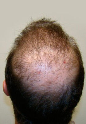 hair transplant photos