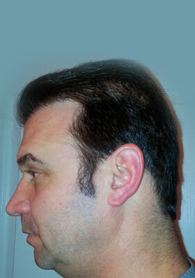 hair transplant photos