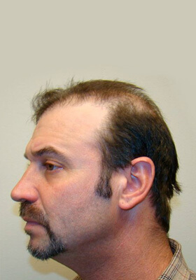 hair transplant photos