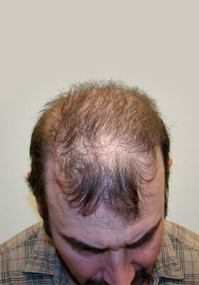 hair transplant photos