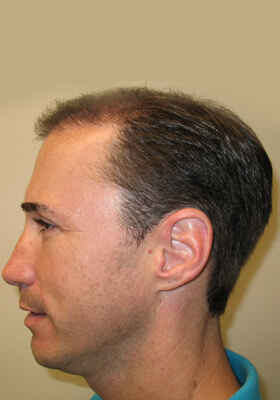 hair transplant photos