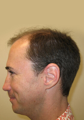 hair transplant before after Photos