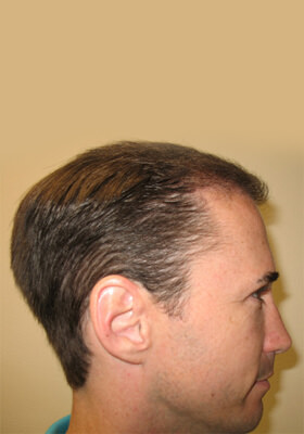 hair transplant photos