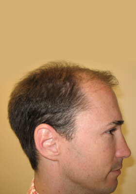 hair transplant before after Photos