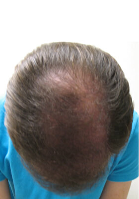 hair transplant photos