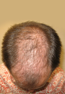 hair transplant before after Photos