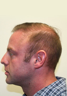 hair transplant photos