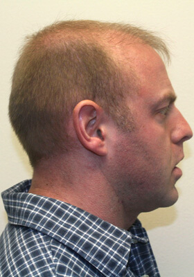 hair transplant photos