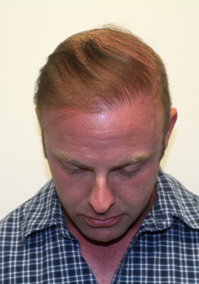 hair transplant before after Photos