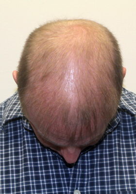 hair transplant before after Photos