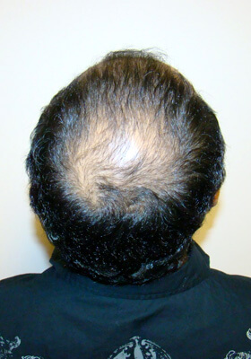 hair transplant before after Photos