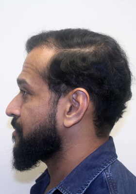 hair transplant before after Photos