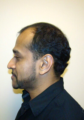 hair transplant before after Photos