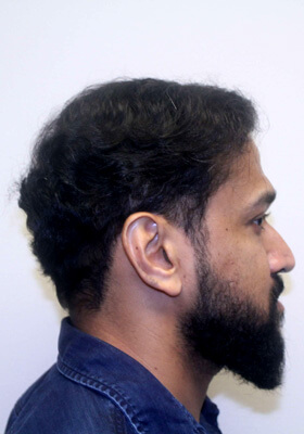 hair transplant photos