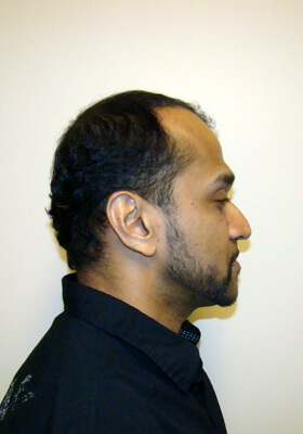hair transplant before after Photos