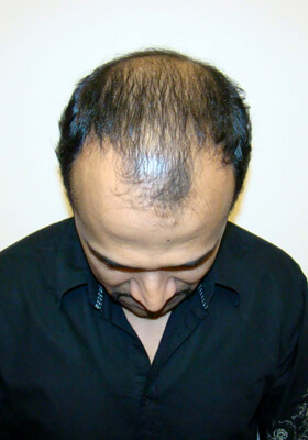 hair transplant before after Photos