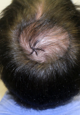 hair transplant before after Photos