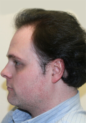 hair transplant photos