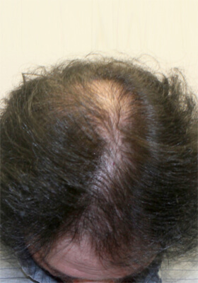 hair transplant photos