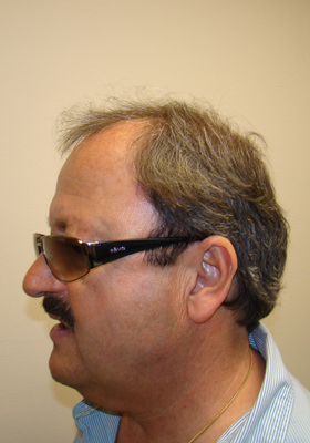 hair transplant photos