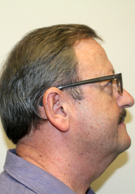hair transplant before after Photos