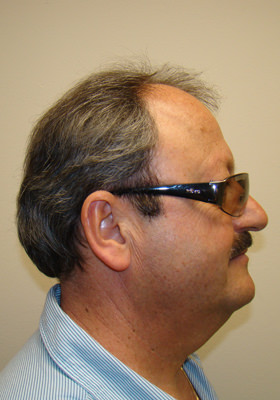 hair transplant before after Photos