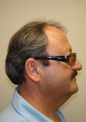 hair transplant photos