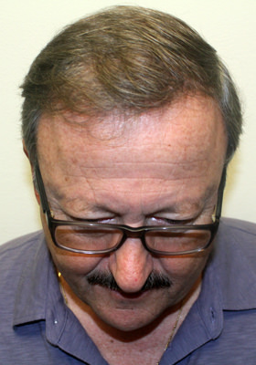 hair transplant before after Photos