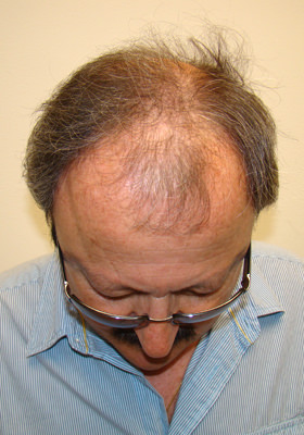 hair transplant photos