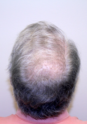 hair transplant before after Photos