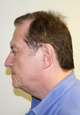 hair transplant before after Photos