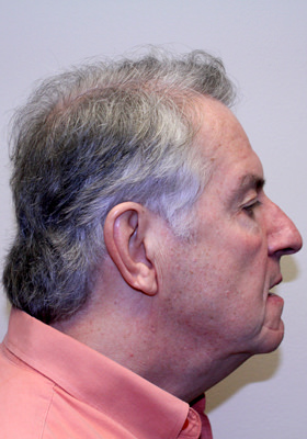hair transplant before after Photos