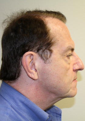 hair transplant before after Photos