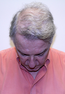 hair transplant photos