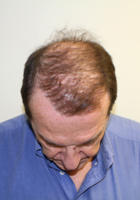 hair transplant before after Photos