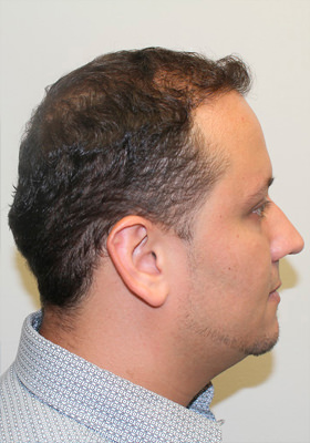 hair transplant before after Photos