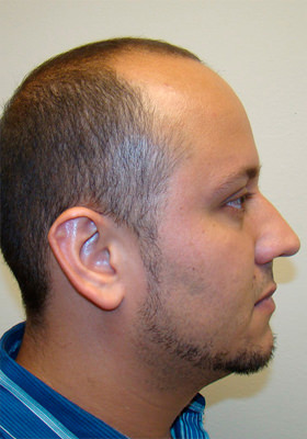 hair transplant photos