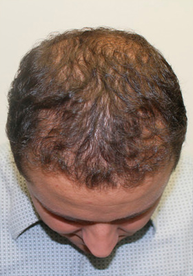 hair transplant before after Photos