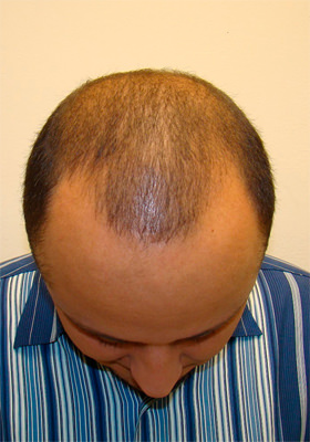 hair transplant photos