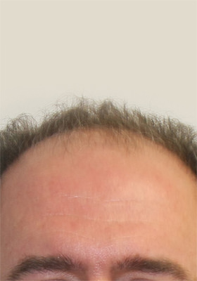 hair transplant before after Photos