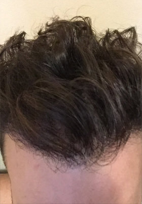 hair transplant photos