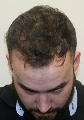 hair transplant photos