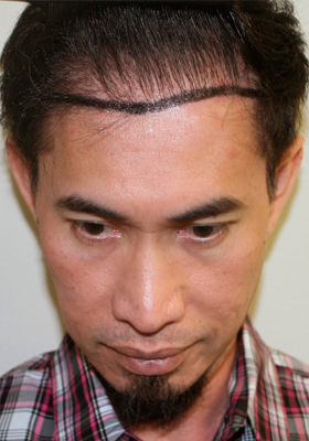 hair transplant before after Photos