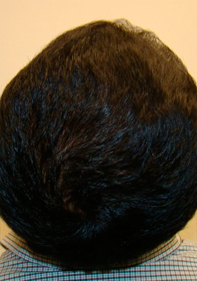 hair transplant photos