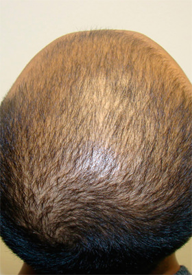 hair transplant photos