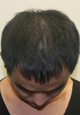 hair transplant photos